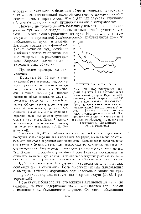 Нормализующее дей-ствие аэроионов на патологически повышенный диурез. Верхняя кривая — суточный диурез в начале и в конце лечения аэроионами. Средняя кривая — количество мочеиспусканий (число позывов) в сутки. Нижняя кривая — количество ночных мочеиспусканий. На ординате — число мочеиспусканий в сутки, на абсциссе — дни лечения аэроионами. (По данным М. И. Рафикова)